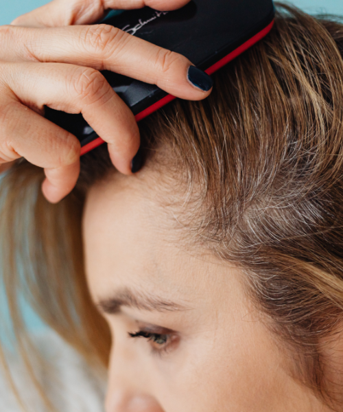 Scalp Micropigmentation